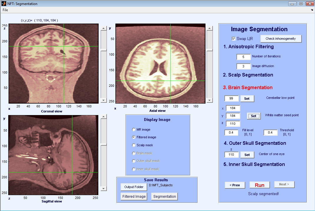 Figure 5: Interface of segmentation during a seed point selection on WM.