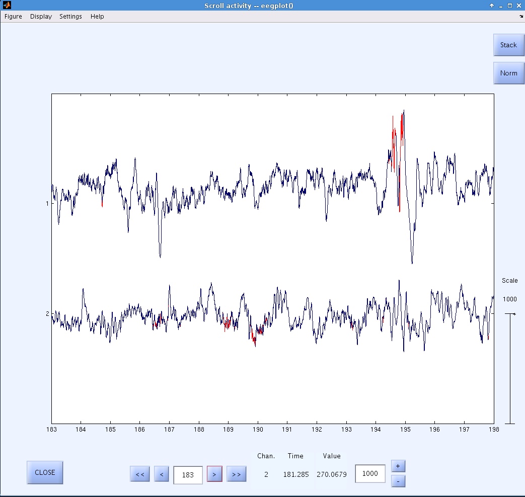 thumb|400px|Figure 3. Detected HFOs (shown in red).